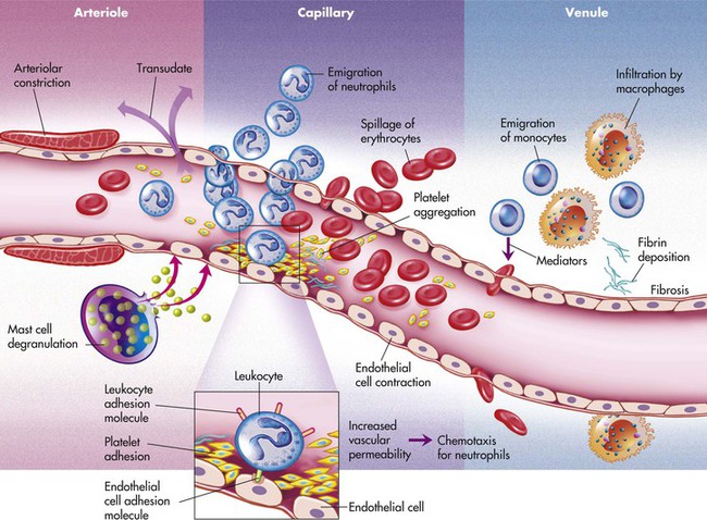 2 Inflammation And Repair Pocket Dentistry 2 Inflammation And Repair Pocket Dentistry