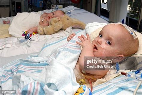 401 Conjoined Twins Surgery Stock Photos High Res Pictures And Images 401 Conjoined Twins Surgery Stock Photos High Res Pictures And Images