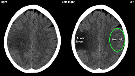 Acute Ischemia Brain