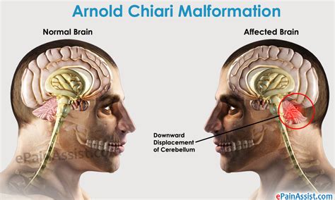 Arnold Chiari Malformation