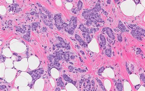 Breast Ductal Carcinoma Breast Ductal Carcinoma