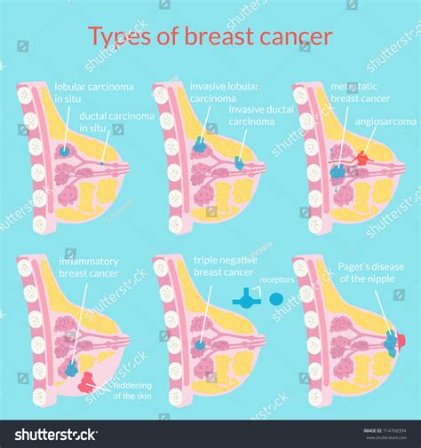 Breast Malignancy Types Breast Malignancy Types