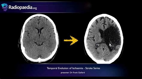 Chronic Cerebral Infarction