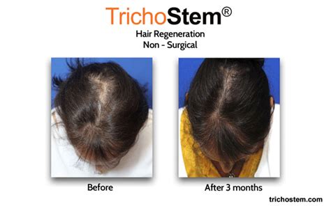 Common Causes Of Hair Loss Trichostem Hair Regeneration Centers Common Causes Of Hair Loss Trichostem Hair Regeneration Centers