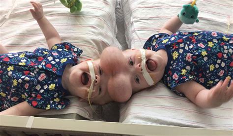Conjoined Twins Surgery
