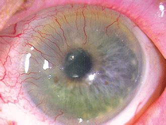 Corneal Neovascularization Corneal Neovascularization