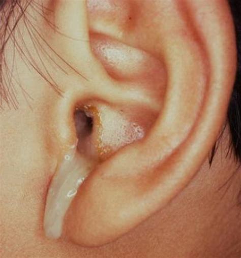Ear Leaking