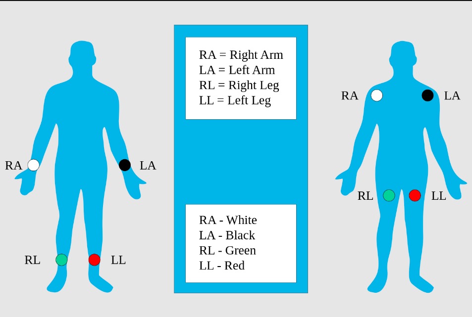 Electrocardiograma Ecg Concise Medical Knowledge Electrocardiograma Ecg Concise Medical Knowledge