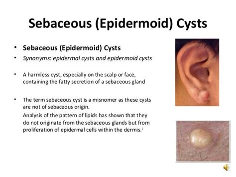 Epidermoid Vs Dermoid Cyst