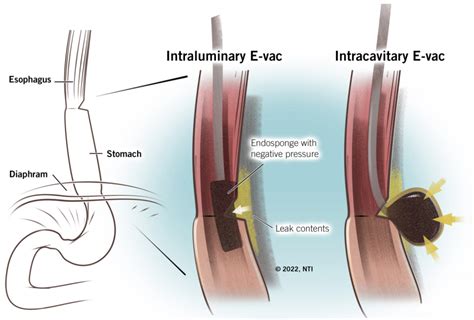 Esophageal Leak