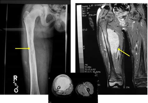 Ewing Sarcoma