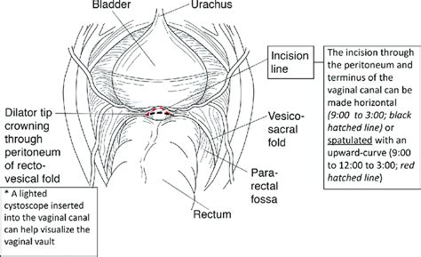 How Deep Is Vaginal Canal