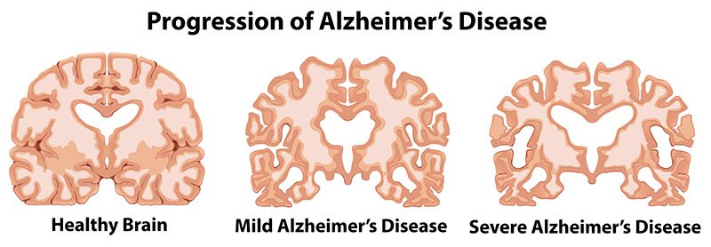 How Do You Die From Alzheimer's