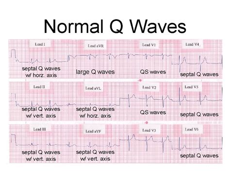 How To Interpret An Ecg Chapter 22 Ecg How To Interpret An Ecg Chapter 22 Ecg