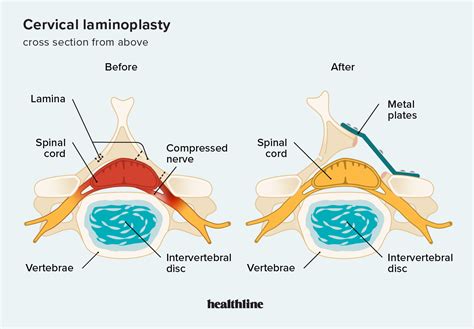 Lamnioplasty