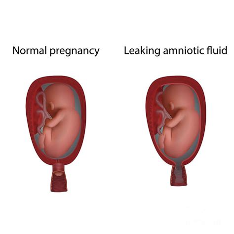 Leaking Placenta