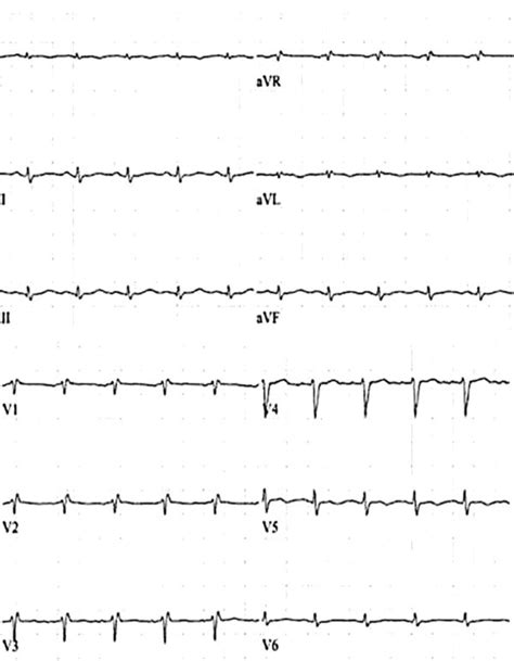 Low Electrocardiographic Qrs Voltage Lqrsv Clincasequest Low Electrocardiographic Qrs Voltage Lqrsv Clincasequest