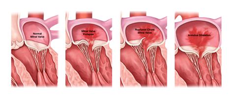 Mitral Valve Leak Treatment