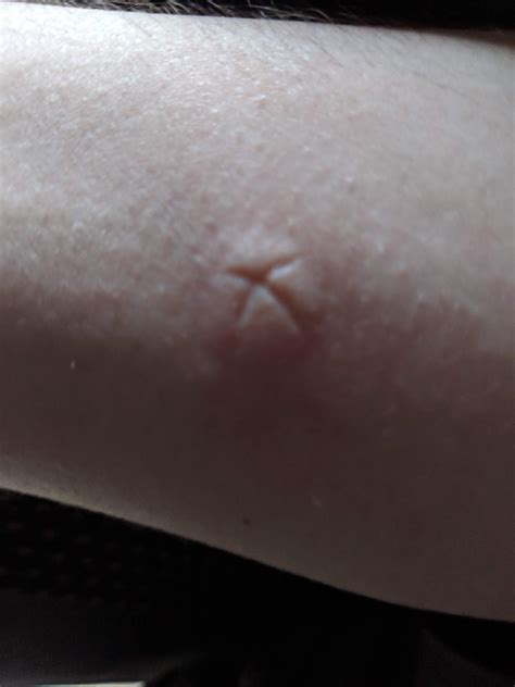 Mosquito Bite Leaking