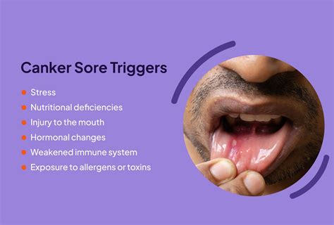 Oral Sex With A Canker Sore