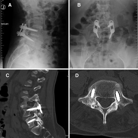 Overpowering Posterior Lumbar Instrumentation And Fusion With Overpowering Posterior Lumbar Instrumentation And Fusion With