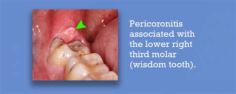 Pericoronitis Infection Pericoronitis Infection