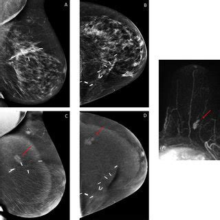 Sixty Five Year Old Woman Treated With Left Breast Conservation Surgery Sixty Five Year Old Woman Treated With Left Breast Conservation Surgery