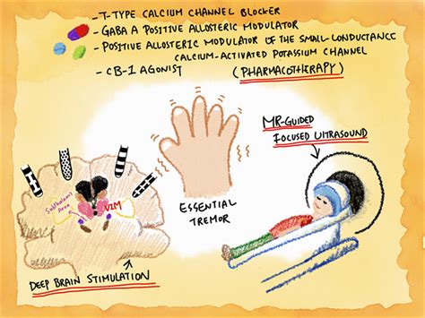 Treatment For Essential Tremors