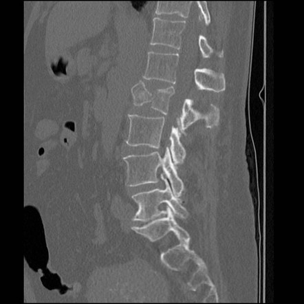 Vertebral Burst Fracture