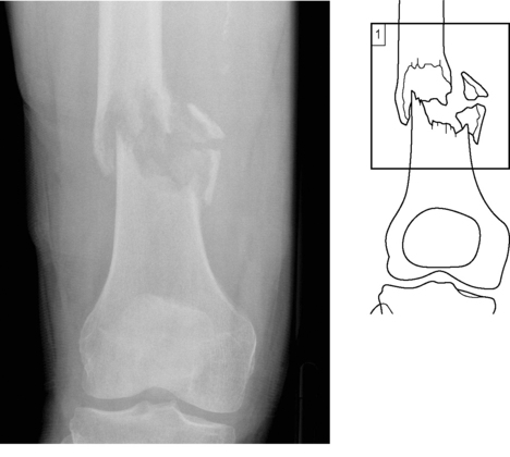 What Is A Pathological Fracture