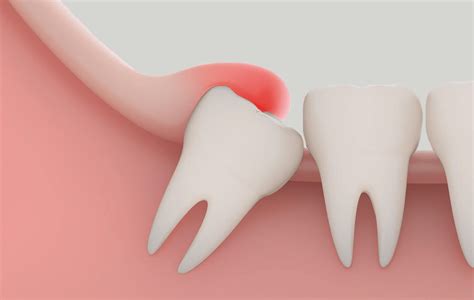 Wisdom Tooth Infection Symptoms Treatment Atlas Dental Wisdom Tooth Infection Symptoms Treatment Atlas Dental
